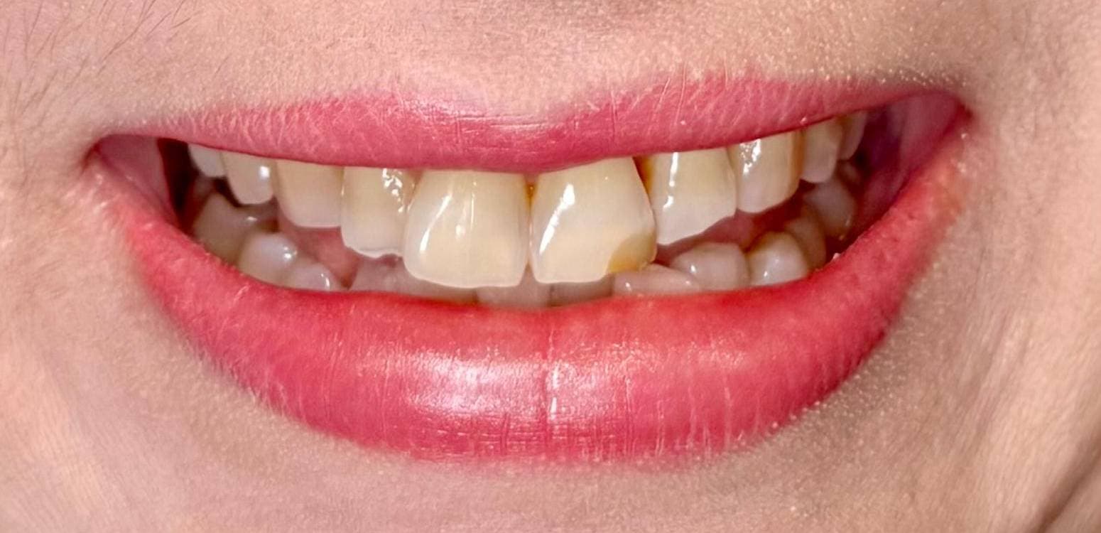 Before dental treatment